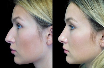 A blonde lady before and after nose job