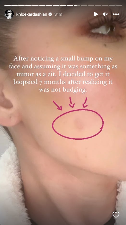 Khloé Kardashian shared a picture of her face tumor on Instagram on Tuesday, October 11, 2022.