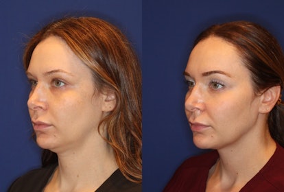 Before and After EmFace Skin Treatment