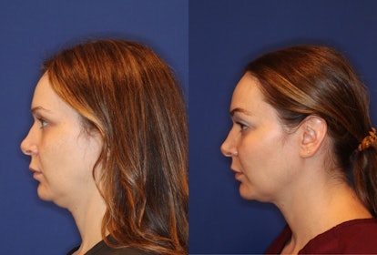 The results of the EmFace treatment 