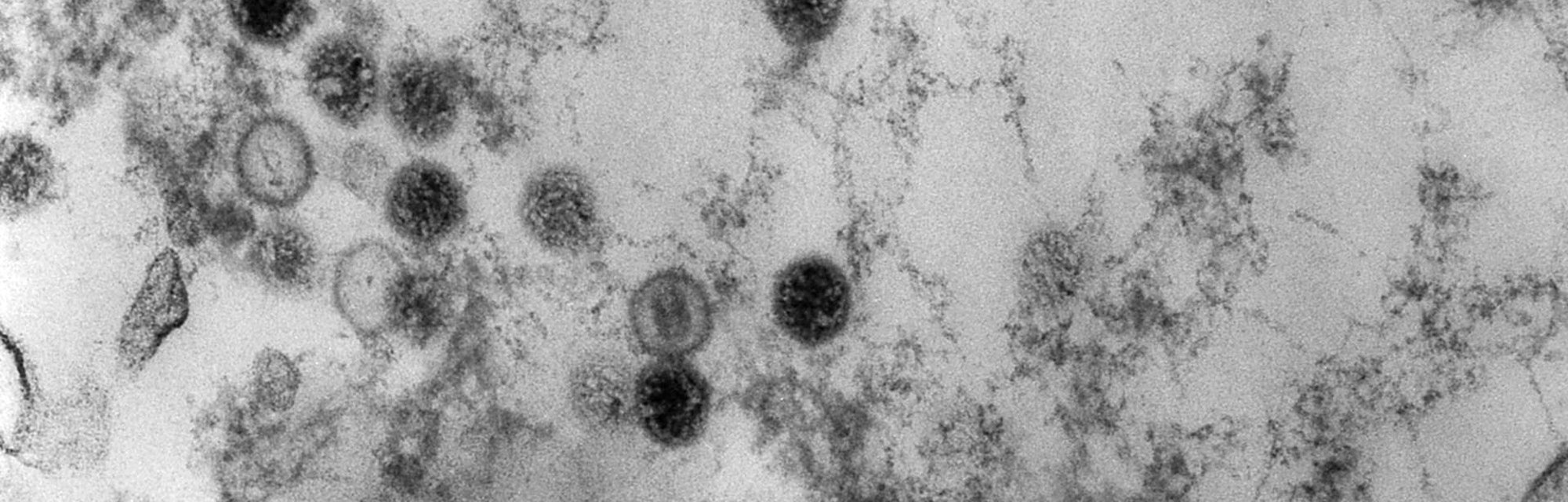 An 1975 electron microscope image reveals several spherical Epstein-Barr virus particles. 