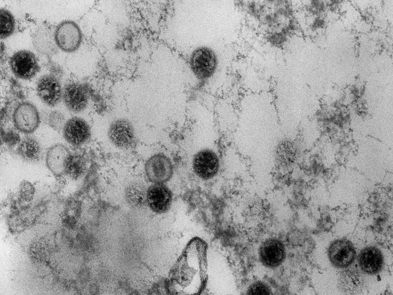 An 1975 electron microscope image reveals several spherical Epstein-Barr virus particles.