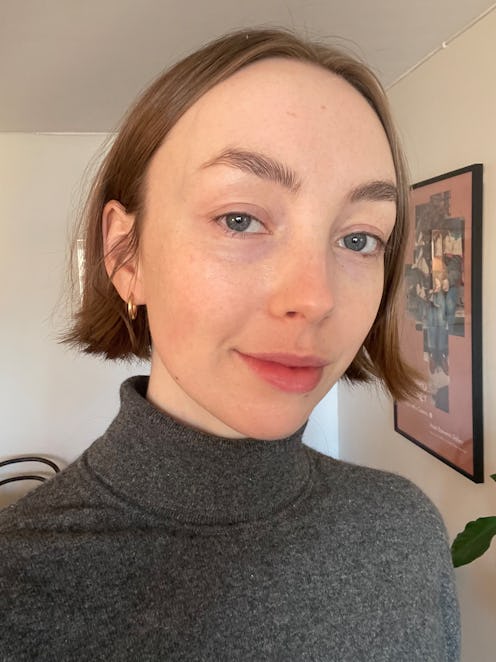 Writer Erika Veurink after Lumecca IPL treatment.