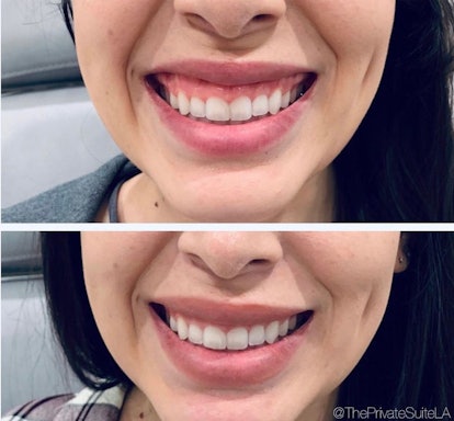 Female lips before and after lip flip