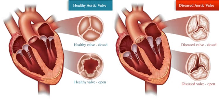 Diagram comparing a heart with a healthy aortic valve and a heart with aortic valve stenosis. The he...