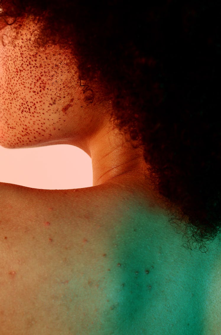 Young woman with bacne, looking for ways to get rid of her body acne, according to dermatologists.