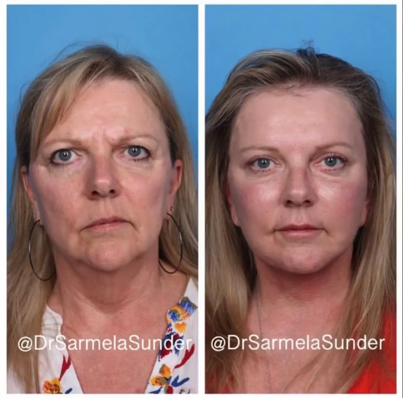 eyelid lift before & after