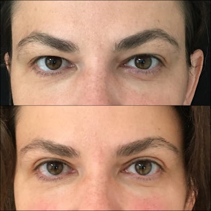eyelid lift before and after