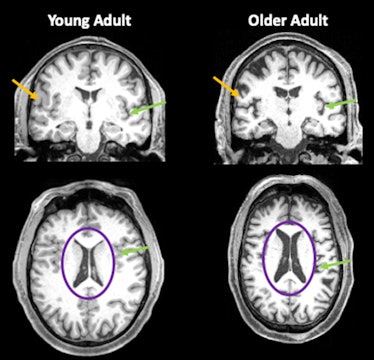 Brain scans from a person in their 30s and a person in their 80s, showing reduced brain volume in th...