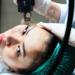 radiofrequency face treatment