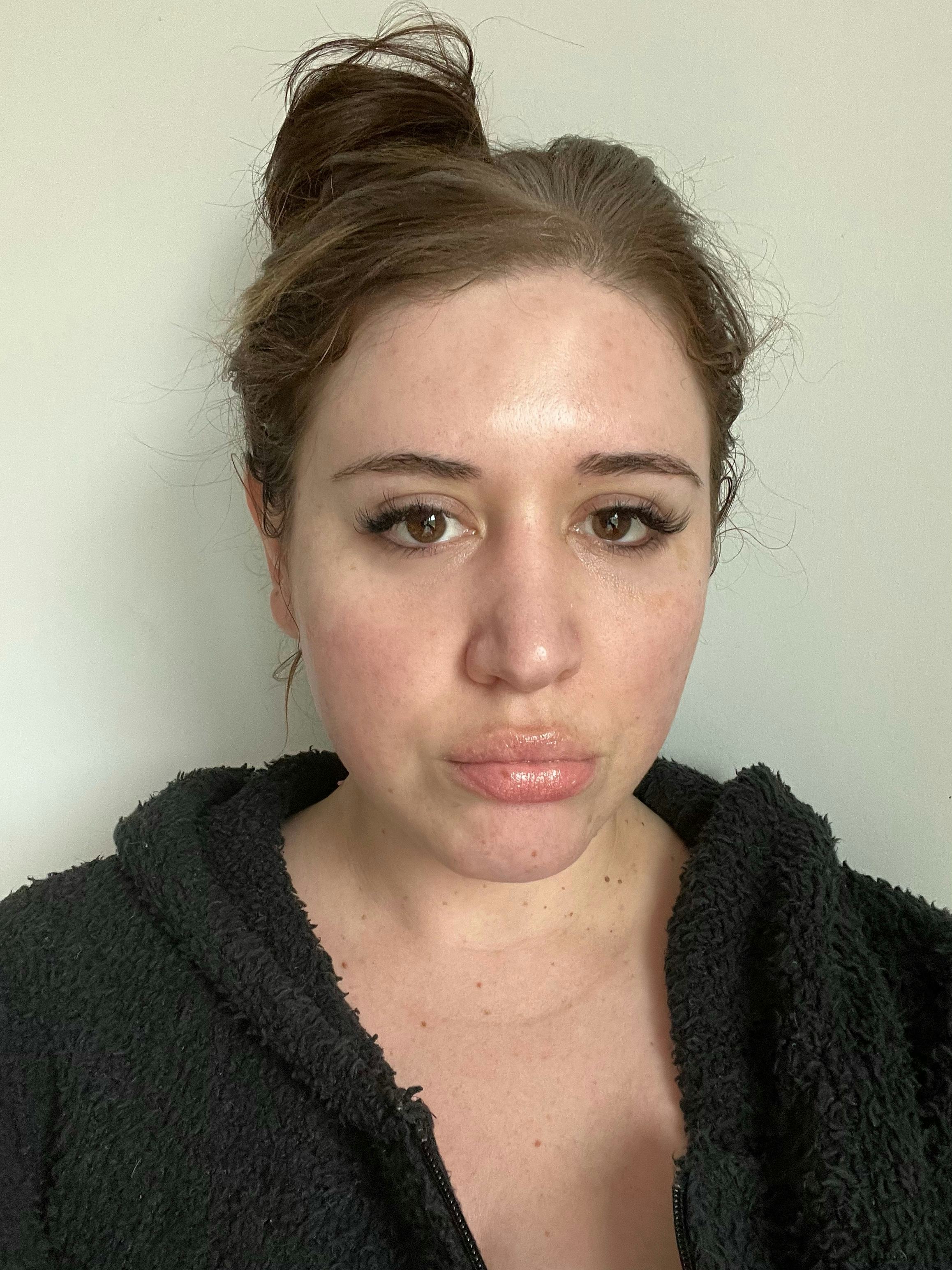 NuFACE before and after before photo