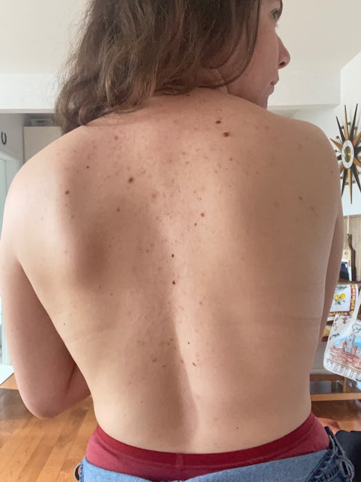 A woman showing off her back acne. 