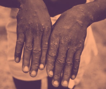 CDC Image of monkeypox patient in Democratic Republic of the Congo, circa 1997