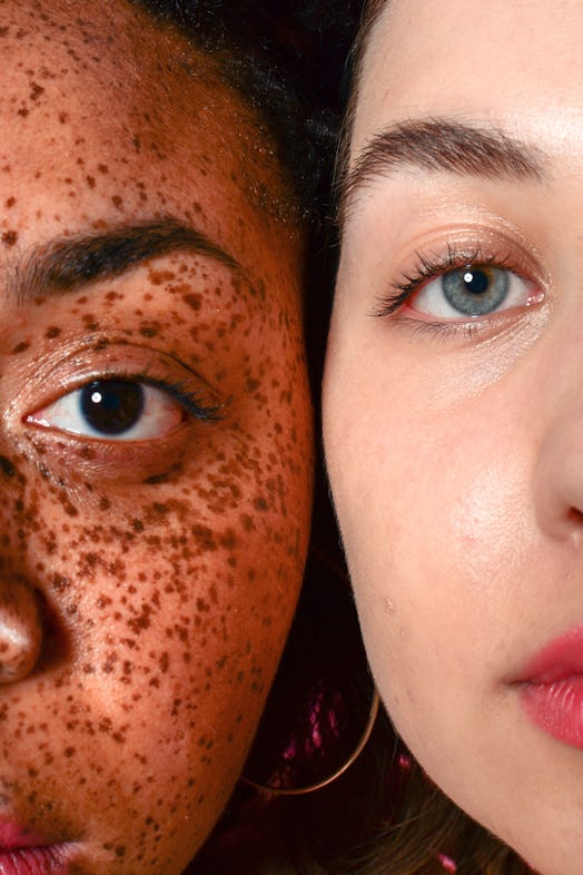 women with freckles and acne scars