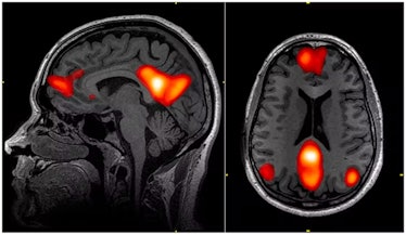 Image of an MRI scan showing the default mode network.