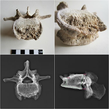 The Pompeiian man’s vertebra shows signs of tuberculosis-inflicted damage. 