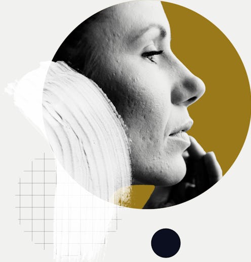 Woman with pitted acne scars