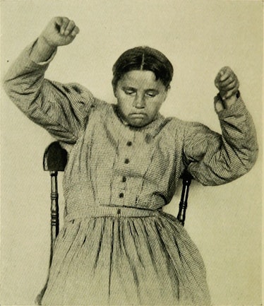 A woman with catatonia ‘posturing.’