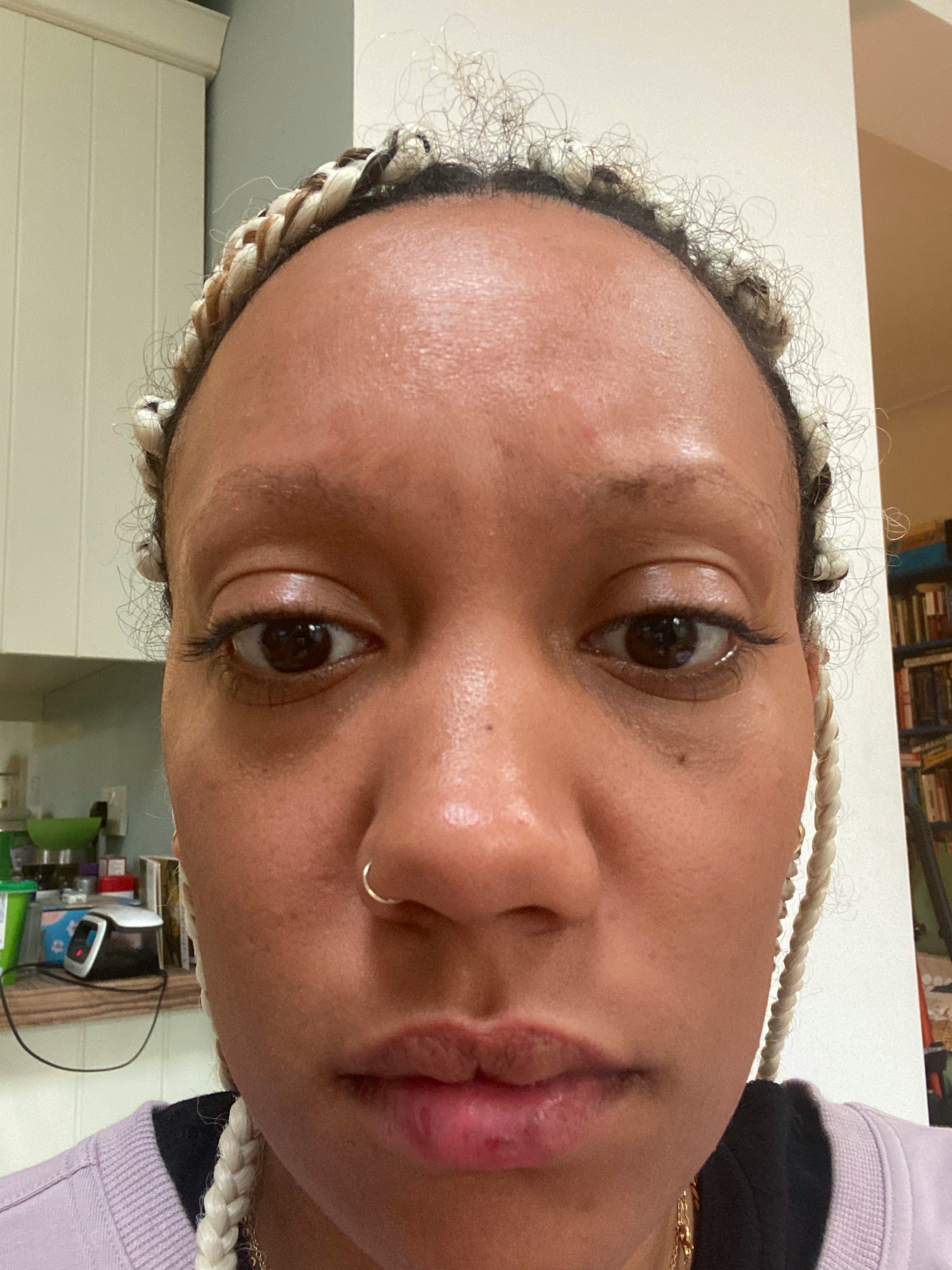 A photo of Jessica Morgan eight months after the 2020 traumatic incident showing eyebrow alopecia.