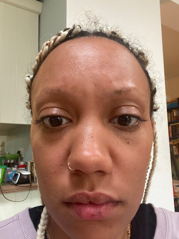 A photo of Jessica Morgan eight months after the 2020 traumatic incident showing eyebrow alopecia. 
