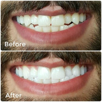 Smile Brilliant Teeth Whitening System