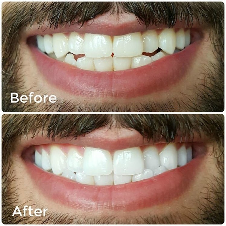 Smile Brilliant Teeth Whitening System