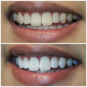 Non-Sensitive Teeth Whitening Systems
