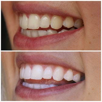 Teeth Whitening Systems For Sensitive Teeth