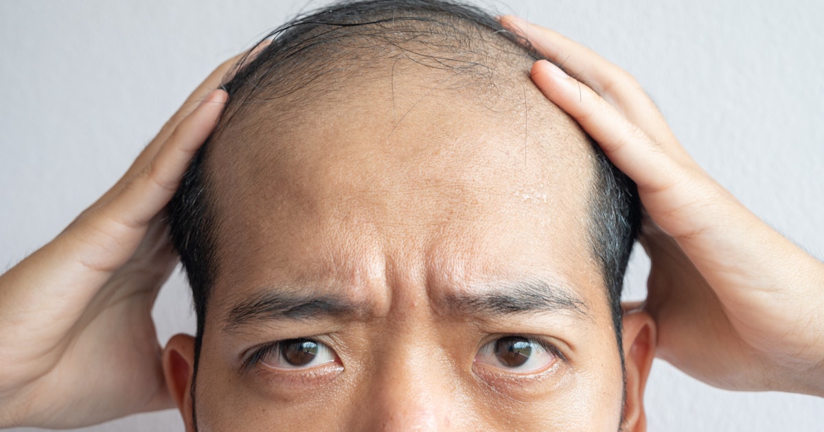 Why Bald Men Spend Middle Age Growing Hair On Their Backs