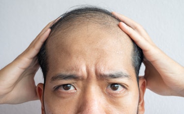Close up of a balding man, worried about his hair loss.