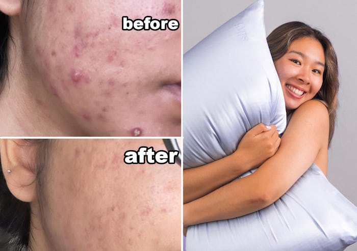 A collage with a woman holding a pillow with the anti-acne pillowcase, and a close-up of skin before...