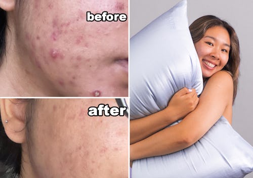 A collage with a woman holding a pillow with the anti-acne pillowcase, and a close-up of skin before...