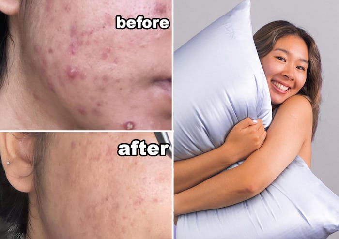 A collage with a woman holding a pillow with the anti-acne pillowcase, and a close-up of skin before...