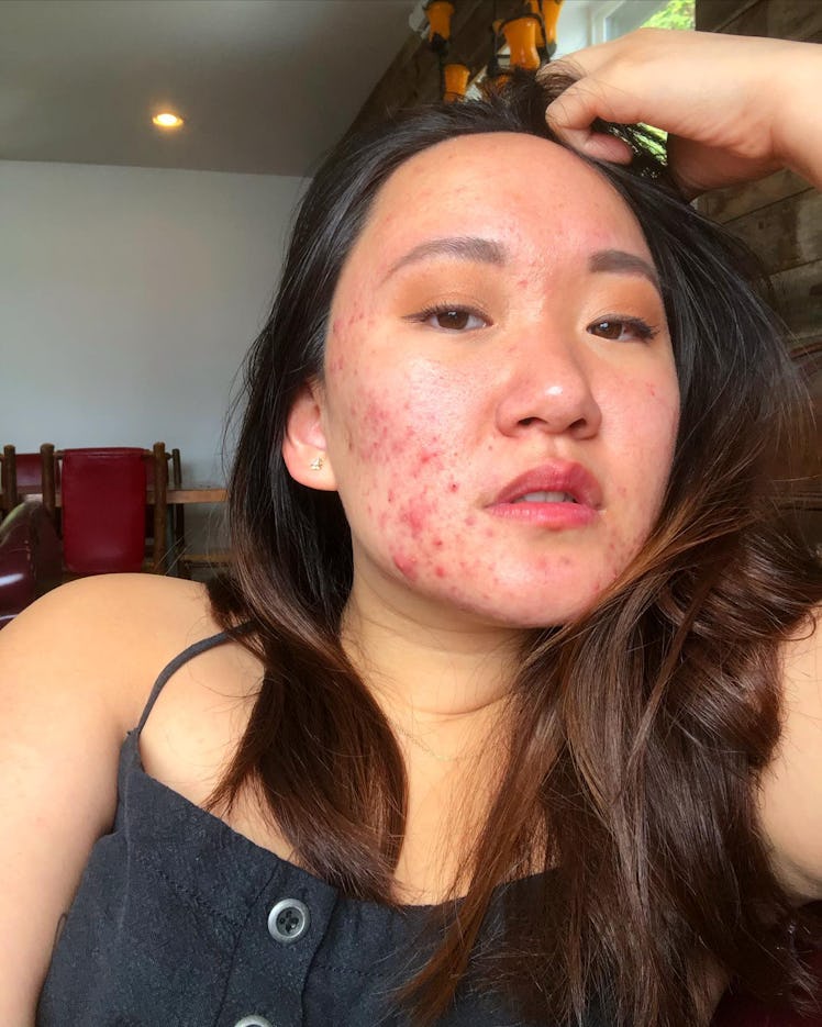 A skin-positive portrait of Katie Gu, an influencer embracing her breakouts.