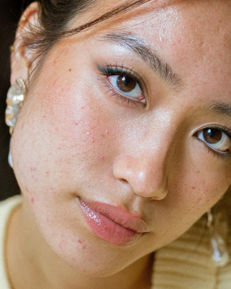 A skin-positive portrait of Shiny Liu, an influencer embracing her breakouts
