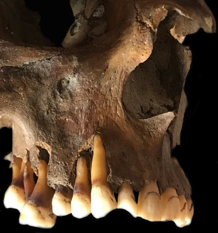 A partial skull with teeth. The teeth show damage that may be due to smoking a clay pipe.