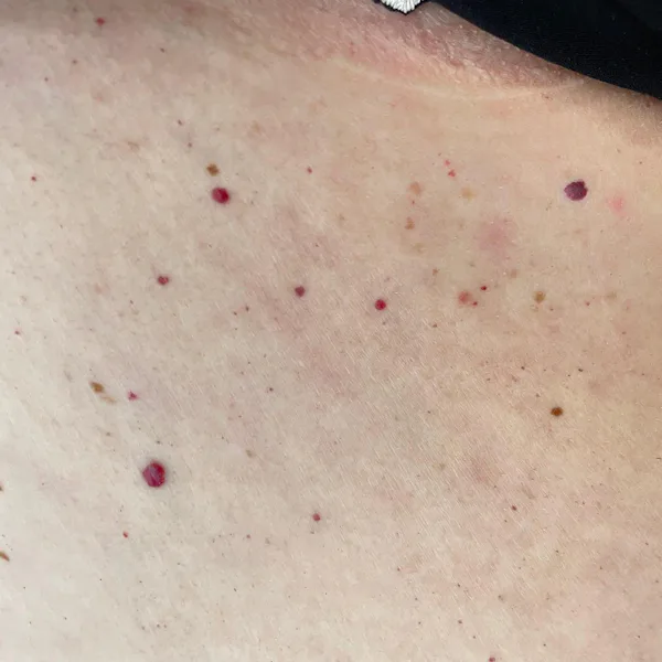 Cherry Type Rash What Causes Cherry Angiomas On Skin & The Best Treatments To Try