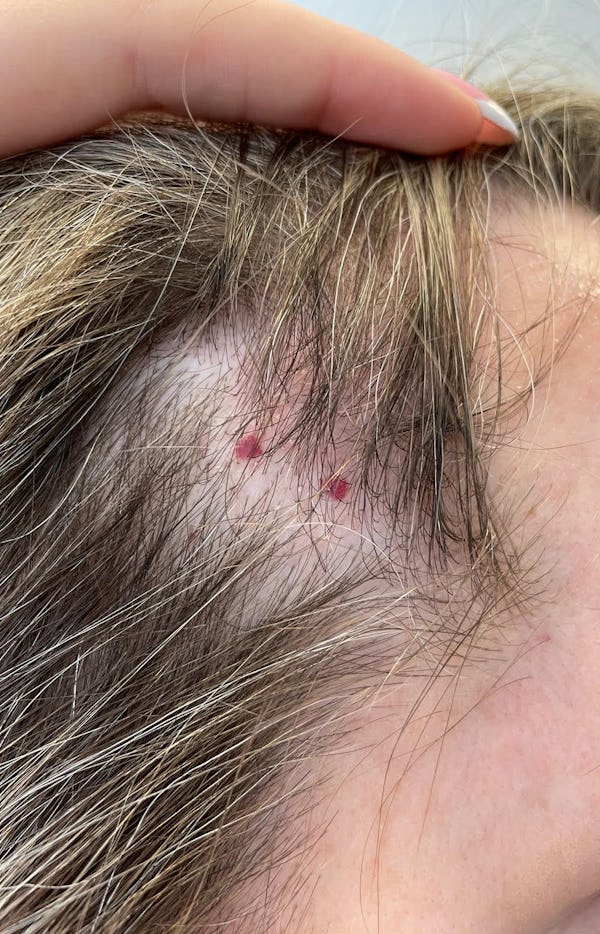 cherry angioma on scalp