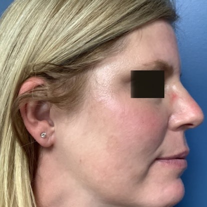A blonde-haired patient with rosacea side view