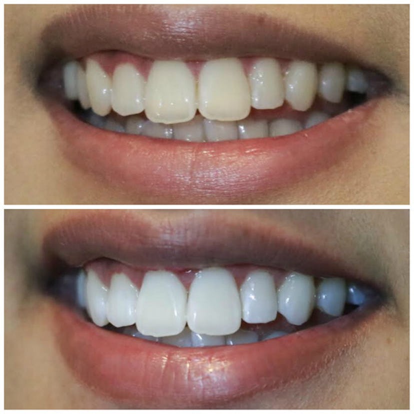 Smile Brilliant is a professional at-home teeth whitening service that doesn't require a dentist.