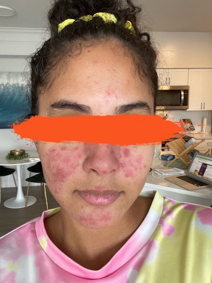 A patient with rosacea with paint-covered eyes