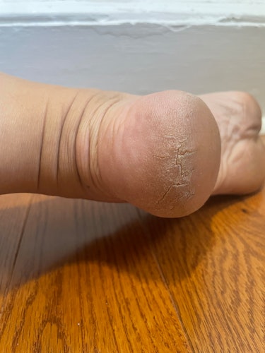 I Tried the Viral Baby Foot Peel and My Feet Have Never Been