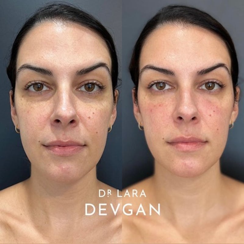 before and after undereye filler