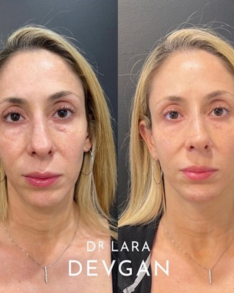 before and after undereye filler