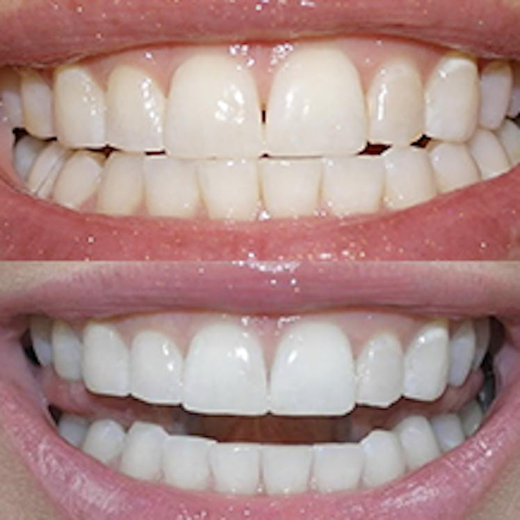 Smile Brilliant is a lab-direct service that lets you whiten teeth professionally at home.