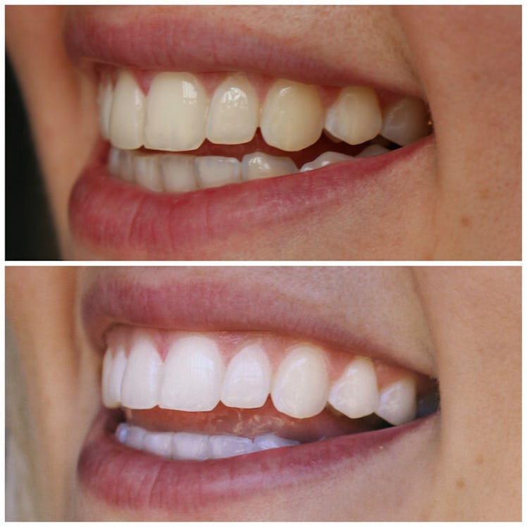 Before and after results show that Smile Brilliant's teeth whitening system works great.