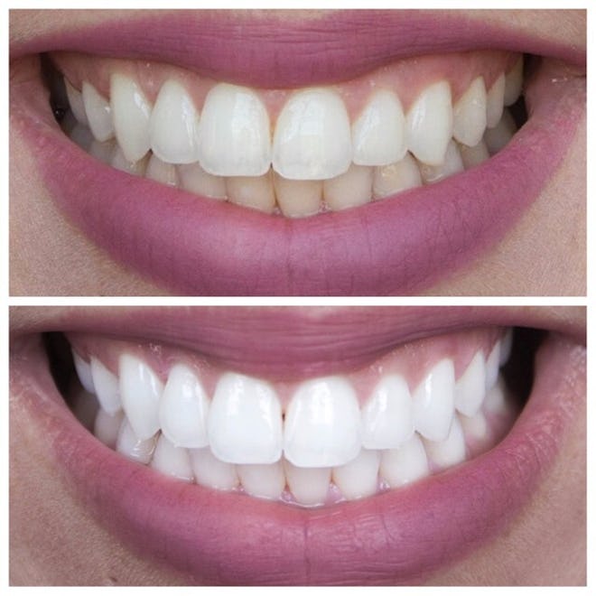 Smile Brilliant's before and after photos prove who well this teeth whitening method works.
