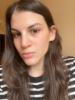 hormonal acne routine