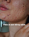 acne skin care influencer