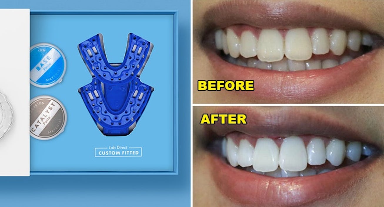 Before and after pictures of whitened teeth with Custom-Fit Whitening Trays next to them